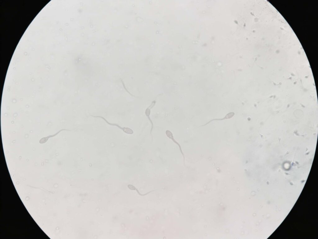 como se ve el semen con microscopio | espermatozides vagos